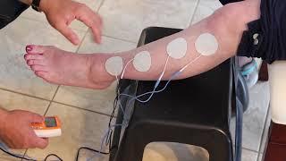 Post Stroke Foot Dorsiflexion: Using Electrical Stimulation to Reduce Tone & Promote Plasticity
