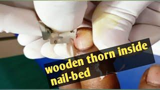 Wooden thorn inside his nail-bed || removal || nail || #whatilearntoday
