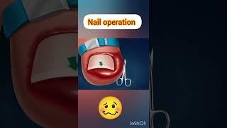 Nail Operation #viralvideo #biology #animation 3D
