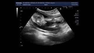 Ultrasound Video showing Club foot fetal anomaly scan.