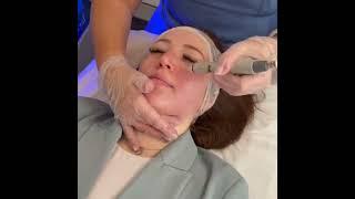 HydraFacial Timelapse | sk:n Clinics