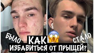 КАК ИЗБАВИТЬСЯ ОТ ПРЫЩЕЙ? | плюс мой уход за кожей и волосами