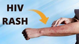 How to Identify an HIV Rash ?