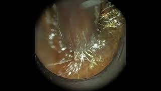 346 - Large Plugs of Ear Wax Removed using the WAXscope®️