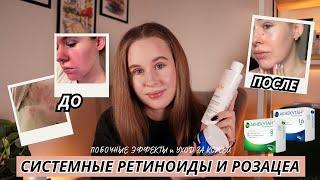 ЛЕЧЕНИЕ РОЗАЦЕА СИСТЕМНЫМИ РЕТИНОИДАМИ (АКНЕКУТАН) | МОЙ ОПЫТ