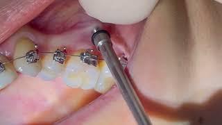 IZC screw, Infra Zygomatic Crest TAD, insertion of IZE mini screw, IZC orthodontic mini implant