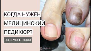 Медицинский Педикюр. Какие Проблемы Ног и Ногтей Может Решить Медицинский Педикюр?
