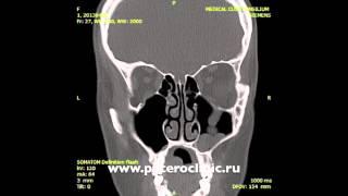 Компьютерная томография носа