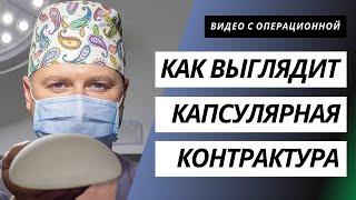 КАК ВЫГЛЯДИТ КАПСУЛЯРНАЯ КОНТРАКТУРА 4 СТЕПЕНИ | УДАЛЕНИЕ ИМПЛАНТАТОВ | ВИДЕО С ОПЕРАЦИОННОЙ