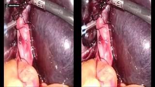 Dr Modi Laparoscopic twisted ovarian cyst salpingo-opherectomy August 2016