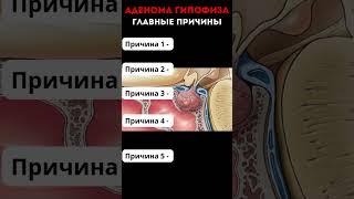 КАК СПАСТИ МОЗГ ОТ АДЕНОМЫ ГИПОФИЗА? #меднавигатор #аденома #мозг