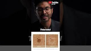 Melasma, Dark Spots, Pigmentation: Ingredient Breakthrough