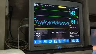 ventilator patent shifting by ambulance     syringe pump monitor ICU fully setup Akshay ambulance