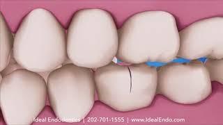 Ideal Endo Cracked Teeth