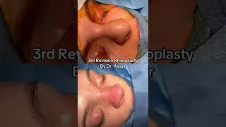 3rd Revision Rhinoplasty #revisionrhinoplasty #revisionnosejob #revisionrhinoplastyexpert #nosejob