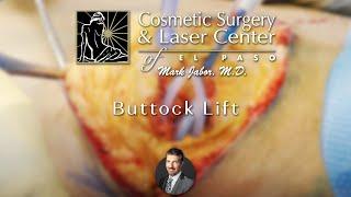 Buttock Lift - Cosmetic Surgery & Laser Center of El Paso