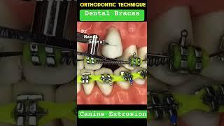 Braces ,  Canine Extrusion wire