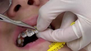 Getting Braces Installed - The First Visit - from Jacksonville University School of Orthodontics