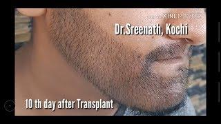 Beard Transplant results after 10 days | Tamil Movie Celebrity | Dr.Sreenath | Beard Transplant