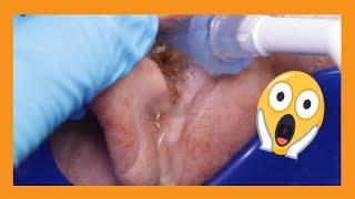 Blocked Ear Cleaning Marathon | Auburn Medical Group