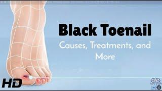 Black Toenail Problems? Learn Causes & Simple Solutions