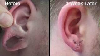 Stretched Earlobe Correction Testimonial - Before and After Photos - Aurora Clinics