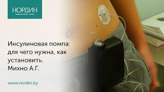 Инсулиновая помпа: для чего нужна, как установить помпу пациенту с сахарным диабетом