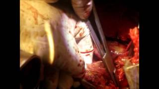 Saccular Aortic arch aneurysm repair