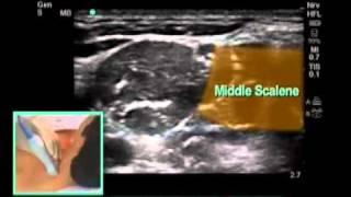 How To: Ultrasound-Guided Interscalene Block Scanning Technique Video