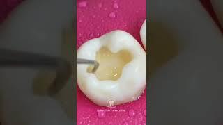 Dental motivation. Direct composite restoration teeth. Dental anatomy. #dentistry  #composite