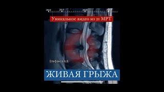 Herniated disc real-time resorption/Рассасывание грыжи без хирургии