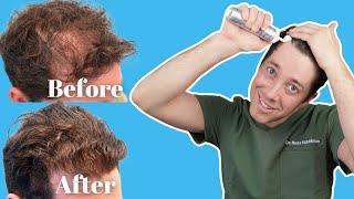 Benefits to Using Minoxidil for Hair Loss