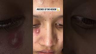 Patches to the rescue  #acne #acnetreatment #cystic #cystpoping #acnepatch #pimplepatch #acnescars