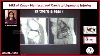 MRI of Knee - Meniscal and Cruciate Ligament Injuries