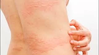 URTICARIA RONCHAS EN EL CUERPO CAUSAS SÍNTOMAS Y TRATAMIENTO