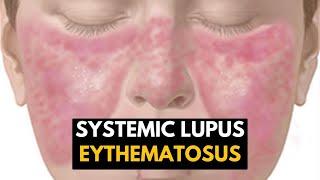 SYSTEMIC LUPUS ERYTHEMATOSUS (BI SYNDROME)