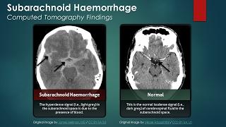 Subarachnoid Hemorrhage (SAH): Computed Tomography Scan Findings