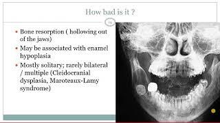 Dentigerous cyst