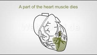 Heart Attack Symptoms