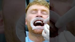 Non-prep Lumineers treatment from Sevil Smile Studio