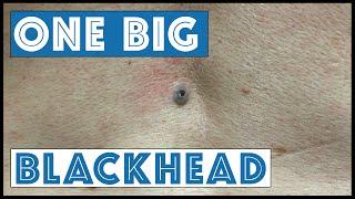One Big Blackhead, aka Dilated Pore of Winer