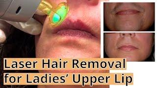Laser Hair Removal for Lip [Dr. Renata Wix-Harris at Reflections in NJ]