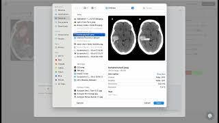 Autogon LabelCraft On Brain CT Scan