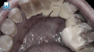 Can You Watch Till the End? Top 3 Most Shocking Tartar Removals!#143
