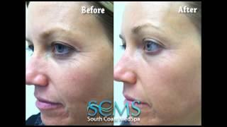 Newport Beach Skin Rejuvenation-Before and After