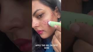 Reviewing: Foxtale one zit acne spot corrector gel should buy one for acne solution 