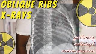 Oblique Ribs X-ray - Positioning, Centering & Marker Tips || Ask The Rad Tech