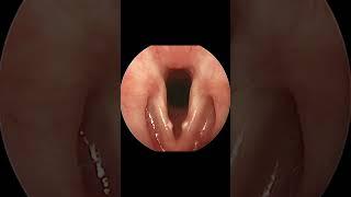 Time Lapse of Vocal Cord Nodule Formation and Resolution