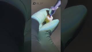 Extracting pulp from isolated teeth in 2 seconds with 𝑃𝑟𝑜-𝐹𝑙𝑒𝑥𝑖 𝐹𝑖𝑙𝑒𝑠 𝐶ℎ𝑎𝑚𝑒𝑙𝑒𝑜𝑛