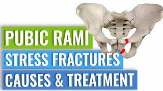 Pubic Ramus Stress Fractures Treatment